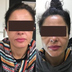 Dr. Carlos Miera - Otoplastia
