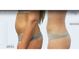 Lipo Vaser High Definition