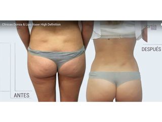 Lipo Vaser High Definition