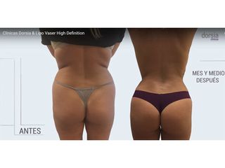 Lipo Vaser High Definition