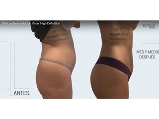 Lipo Vaser High Definition