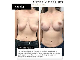 Mastopexia