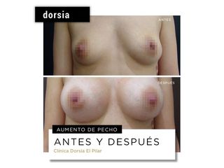 Aumento de pecho - Dorsia Clinicas De Estética