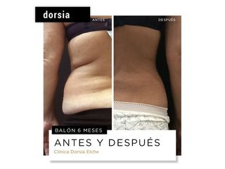 Balón gástrico - Dorsia Clinicas De Estética