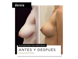 Mastopexia - Dorsia Clinicas De Estética