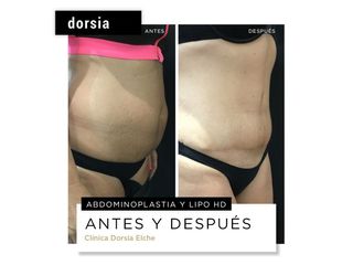 Abdominoplastia - Dorsia Clinicas De Estética