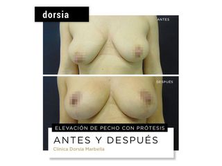 Aumento de pecho - Dorsia Clinicas De Estética