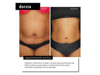 Abdominoplastia - Dorsia Clinicas De Estética