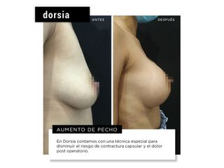 Aumento de pecho - Dorsia Clinicas De Estética