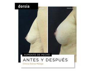 Aumento de pecho - Dorsia Clinicas De Estética