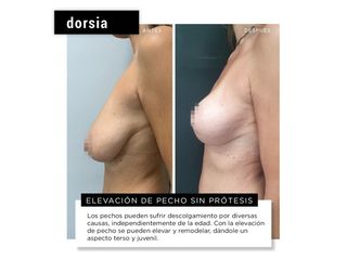 Aumento de pecho - Dorsia Clinicas De Estética