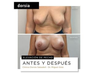 Mastopexia - Dorsia Clinicas De Estética