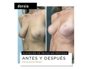 Aumento de pecho - Dorsia Clinicas De Estética