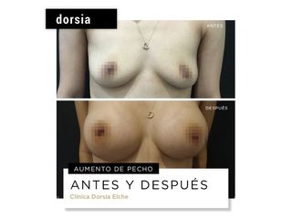 Aumento de pecho - Dorsia Clinicas De Estética