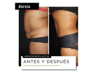 Abdominoplastia - Dorsia Clinicas De Estética