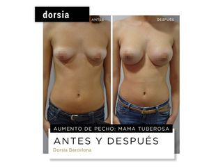 Aumento de pecho - Dorsia Clinicas De Estética