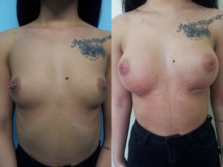 Aumento de pecho - Dra. Banacu Luminita