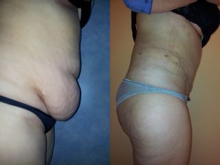 Abdominoplastia - Dra. Banacu Luminita