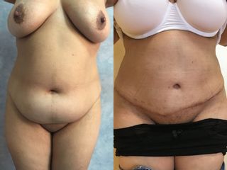 Abdominoplastia - Dra. Banacu Luminita