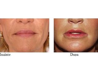 Aumento de labios - Dra. Banacu Luminita