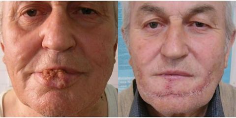 Facial Reconstructive Surgery - Malignant skin tumors