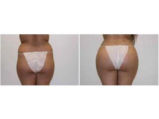 LIFTINGUL DE FESE BRAZILIAN  ( FESE BRAZILIENE) Fotografii