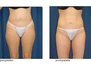 Liposucția, Lipoaspiratia, metodă chirurgicală de îndepărtare a grăsimilor