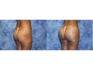 LIFTINGUL DE FESE BRAZILIAN  ( FESE BRAZILIENE) Fotografii