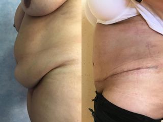 Abdominoplastie înainte și după imagine