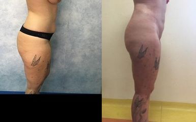 Basic  liposuction
