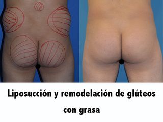 Antes y después liposuccion