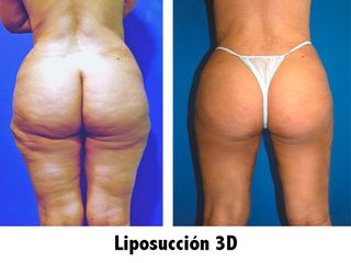 Antes y después liposuccion