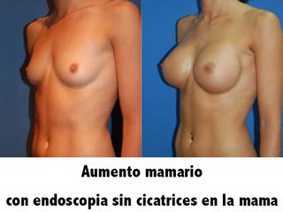 Antes y después aumento de pecho