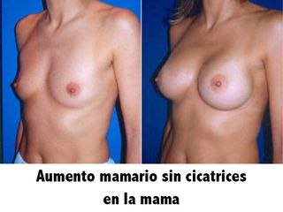 Antes y después aumento de pecho