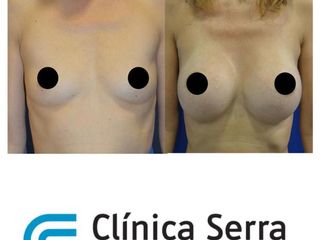 Antes y después Aumento de mamás con prótesis 