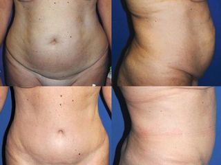 Antes y después Abdominoplastia