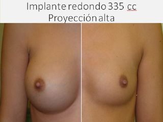 Antes y después aumento de pecho : Implante redondo - 355 cc - Alta proyección