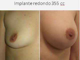 Antes y después aumento de pecho : Prótesis redonda - 355cc 