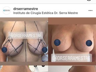 Antes y después mastopexia con implantes 