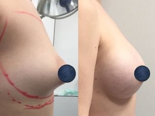 Antes y después aumento mamario en mama tuberosa