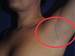 Cicatriz de aumento mamario via axilar. 1 año post cirurgía . Dr Serra Mestre