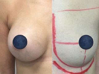 Antes y después Aumento de pecho