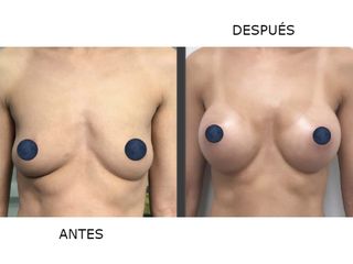 Antes y después Aumento de pecho