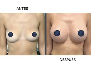 Antes y después Aumento seno con implante redondo 375 cc