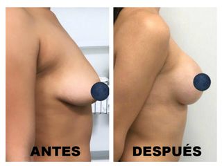 Antes y después Mastopexia 