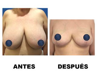 Antes y después Reducción de senos