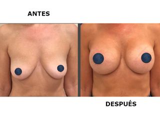 Antes y después Aumento de pecho