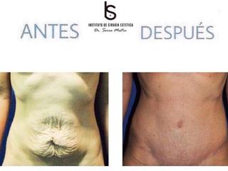 Antes y después Abdominoplastia