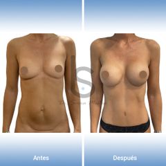 Mommy Makeover - Dr. José María Serra Mestre
