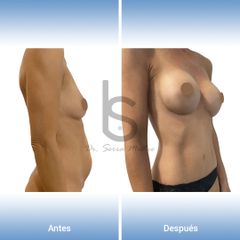 Mommy Makeover - Dr. José María Serra Mestre